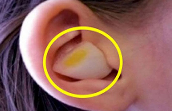 Treat ear infections with a garlic clove?!